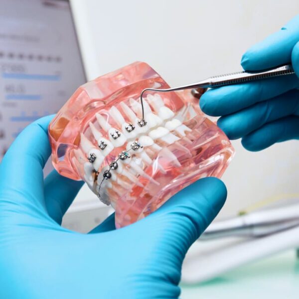 At R3 Dental Group, we offer traditional metal braces to patients located in Silver Spring, Germantown, Frederick, and the surrounding areas of Maryland.