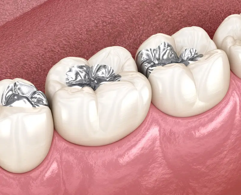 Amalgam Fillings