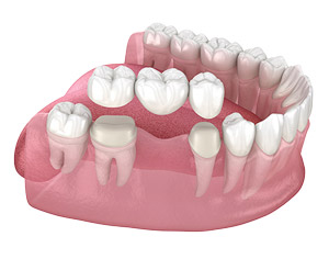Dental Bridges