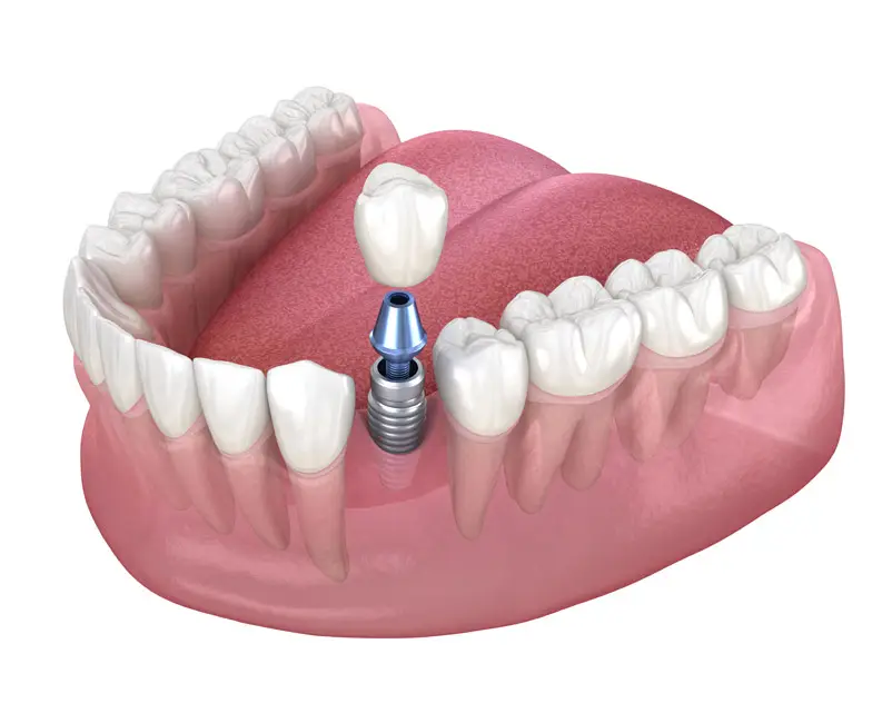 Dental Implants
