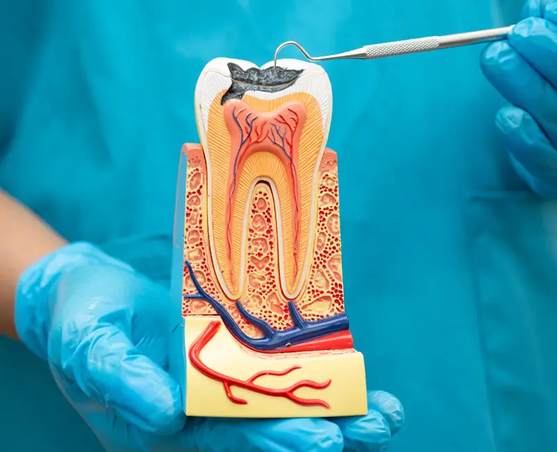 Root Canals