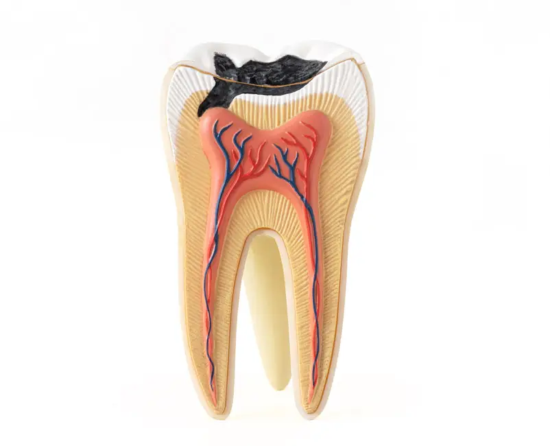 Tooth Decay