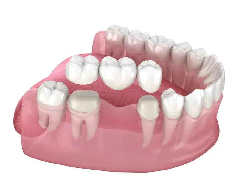 Types of Crowns